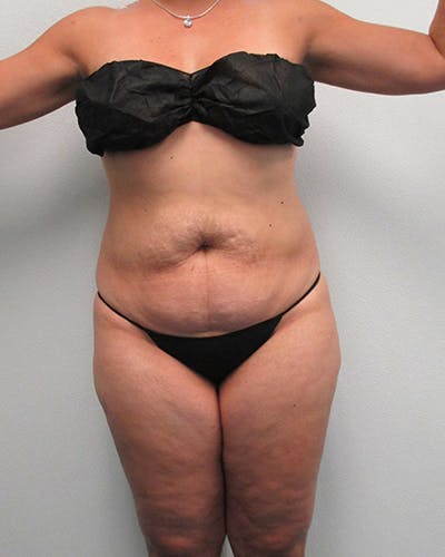 Tummy Tuck Before & After Gallery - Patient 316019 - Image 1