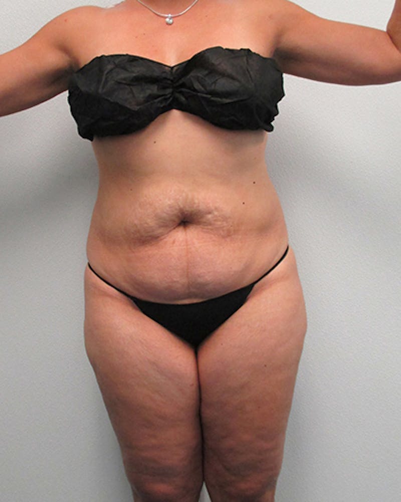Tummy Tuck Before & After Gallery - Patient 316019 - Image 1