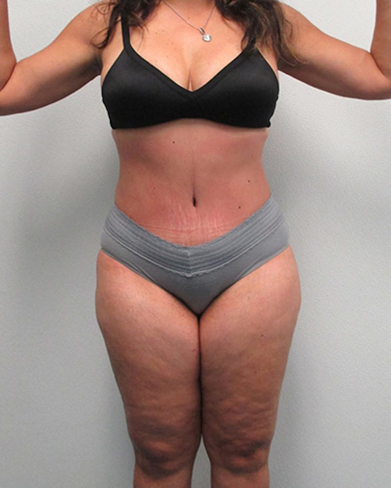 Tummy Tuck Before & After Gallery - Patient 316019 - Image 2
