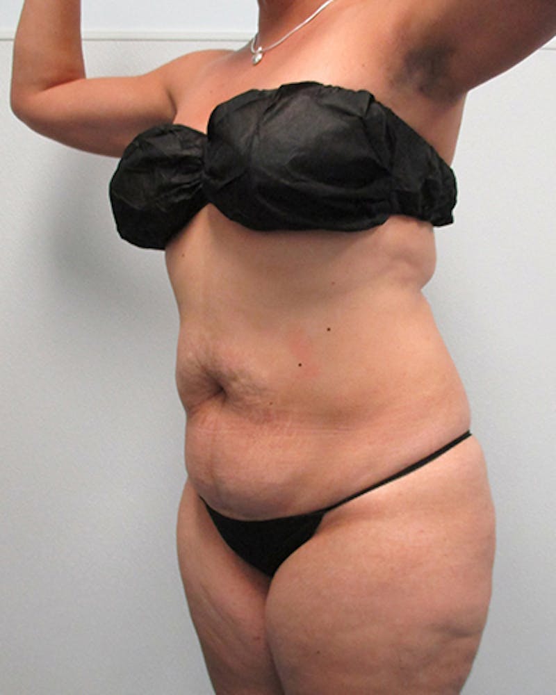 Tummy Tuck Before & After Gallery - Patient 316019 - Image 3