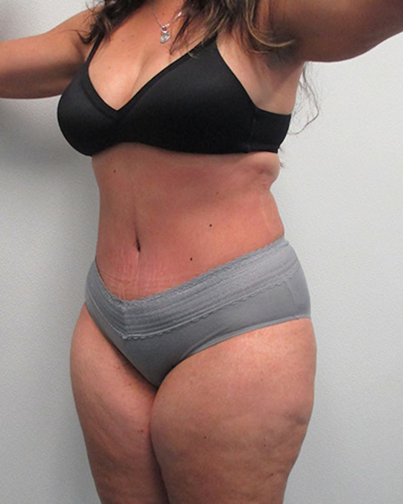 Tummy Tuck Before & After Gallery - Patient 316019 - Image 4