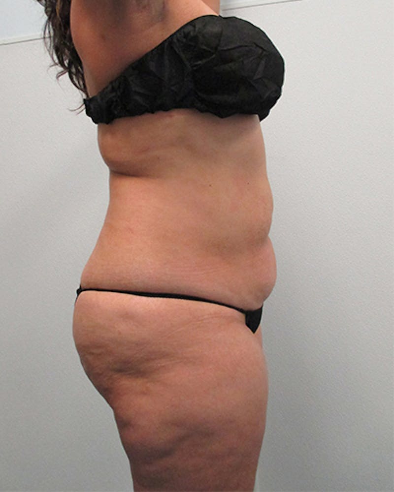 Tummy Tuck Before & After Gallery - Patient 316019 - Image 5
