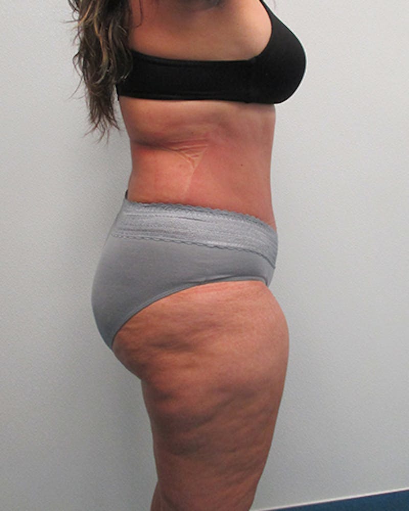 Tummy Tuck Before & After Gallery - Patient 316019 - Image 6