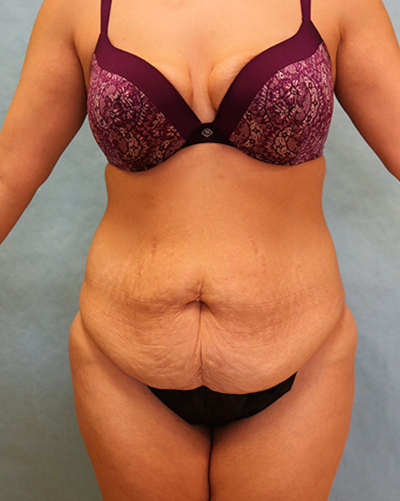 Tummy Tuck Before & After Gallery - Patient 371337 - Image 1