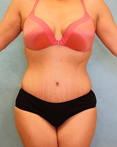 Tummy Tuck Before & After Gallery - Patient 371337 - Image 2