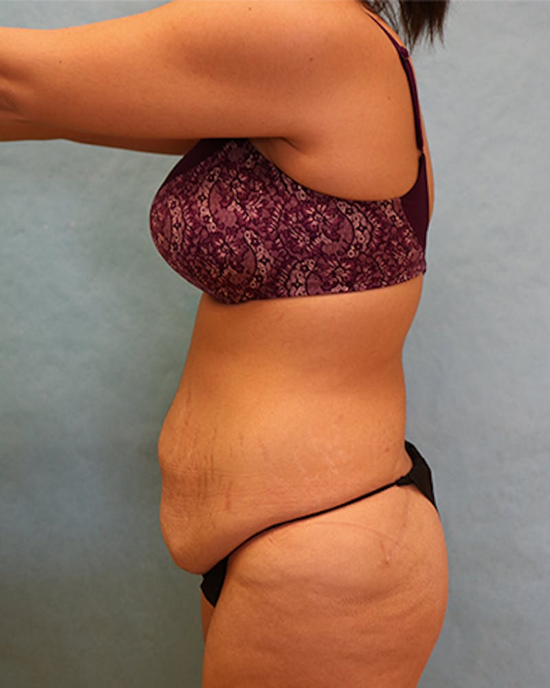 Tummy Tuck Before & After Gallery - Patient 371337 - Image 3