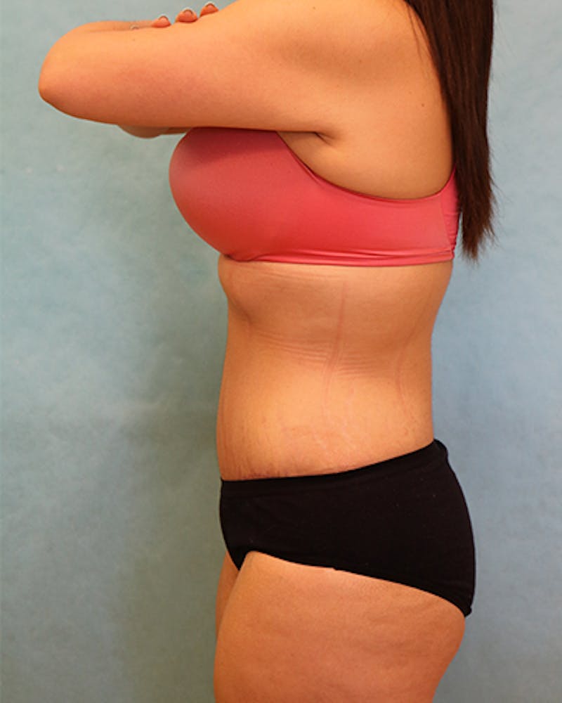 Tummy Tuck Before & After Gallery - Patient 371337 - Image 4
