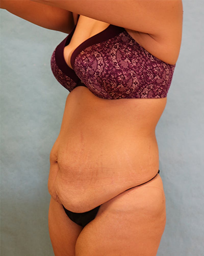 Tummy Tuck Before & After Gallery - Patient 371337 - Image 5