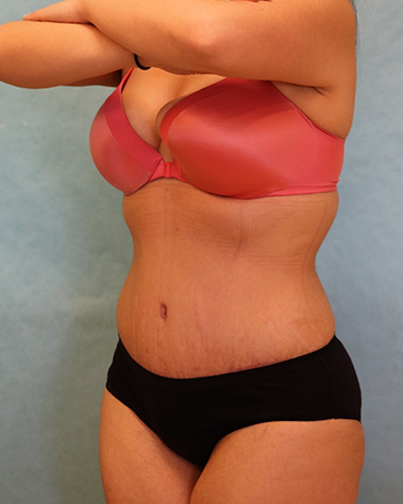 Tummy Tuck Before & After Gallery - Patient 371337 - Image 6