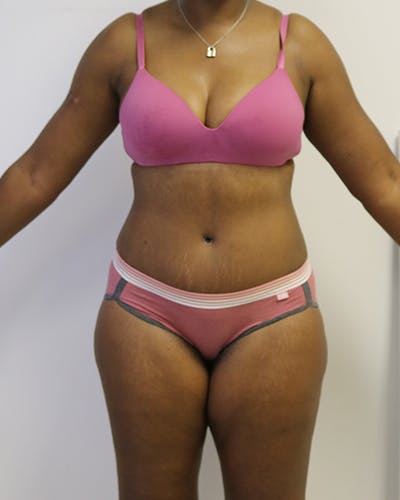 Tummy Tuck Before & After Gallery - Patient 225552 - Image 2