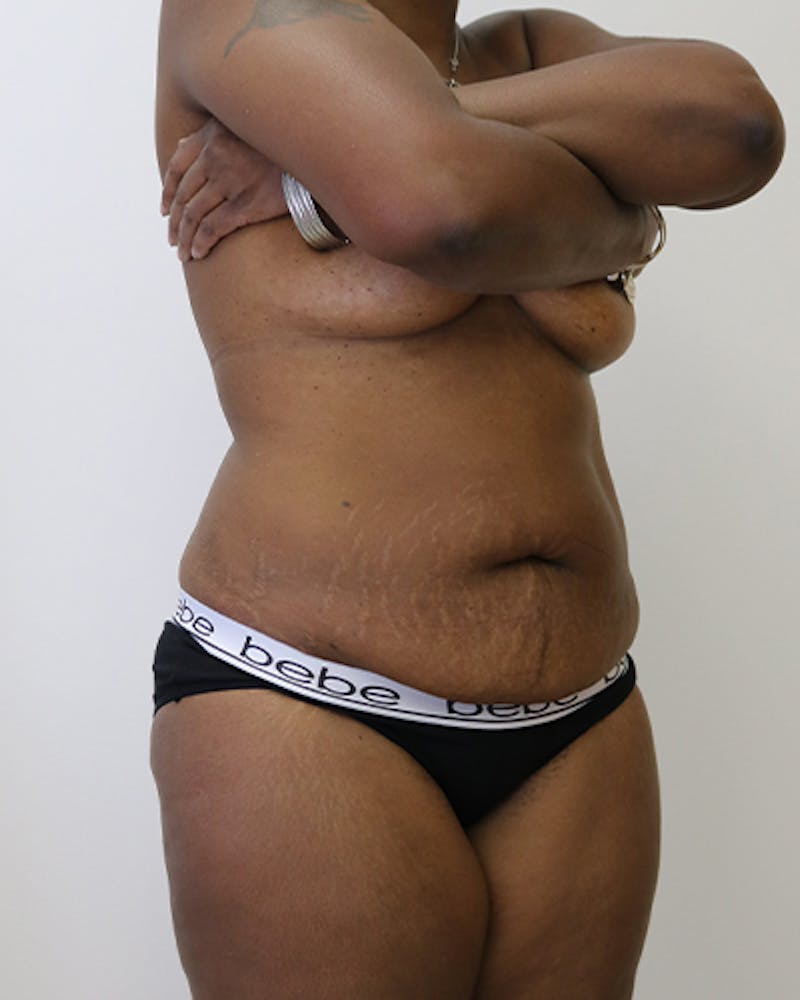 Tummy Tuck Before & After Gallery - Patient 225552 - Image 5