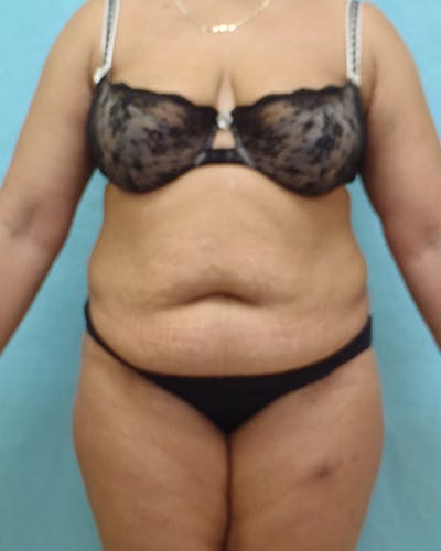 Tummy Tuck Before & After Gallery - Patient 441951 - Image 1