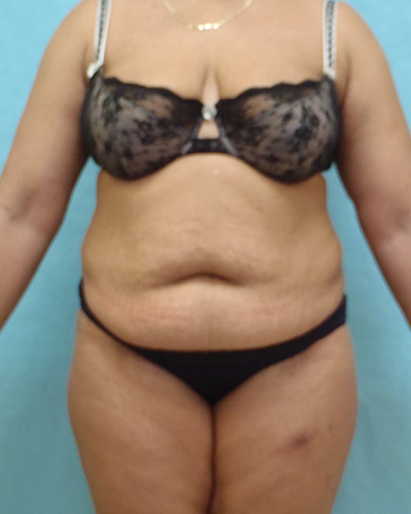 Tummy Tuck Before & After Gallery - Patient 441951 - Image 1