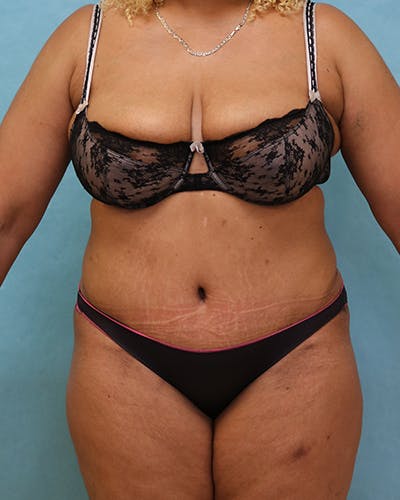 Tummy Tuck Before & After Gallery - Patient 441951 - Image 2