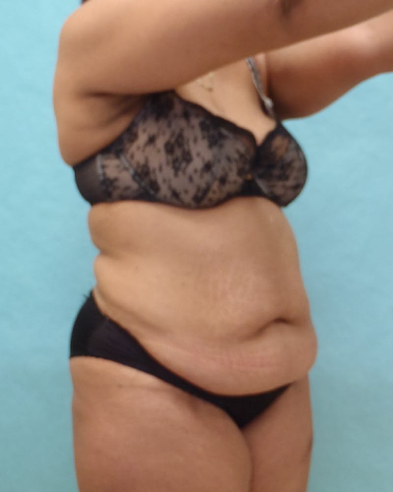 Tummy Tuck Before & After Gallery - Patient 441951 - Image 3