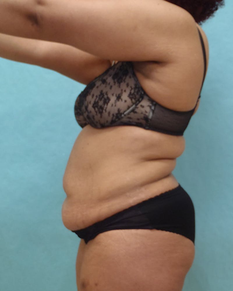 Tummy Tuck Before & After Gallery - Patient 441951 - Image 5