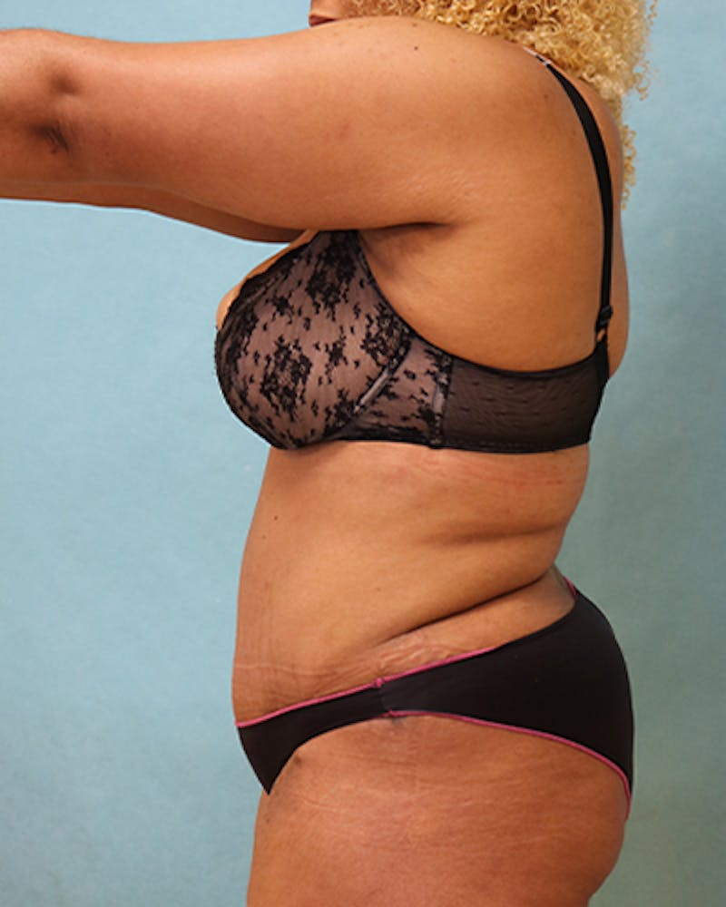 Tummy Tuck Before & After Gallery - Patient 441951 - Image 6