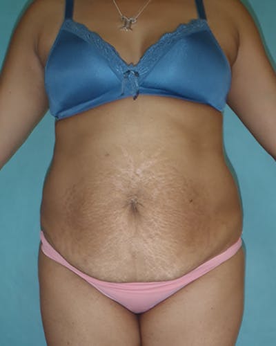 Tummy Tuck Before & After Gallery - Patient 550823 - Image 1