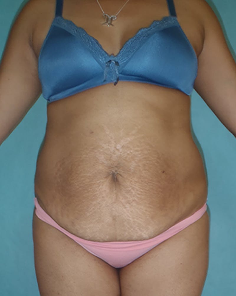 Tummy Tuck Before & After Gallery - Patient 550823 - Image 1