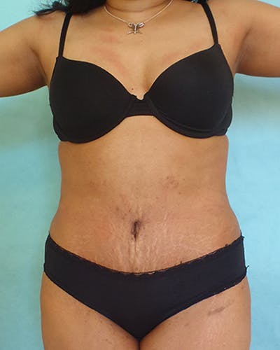 Tummy Tuck Before & After Gallery - Patient 550823 - Image 2