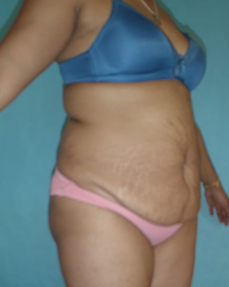 Tummy Tuck Before & After Gallery - Patient 550823 - Image 3