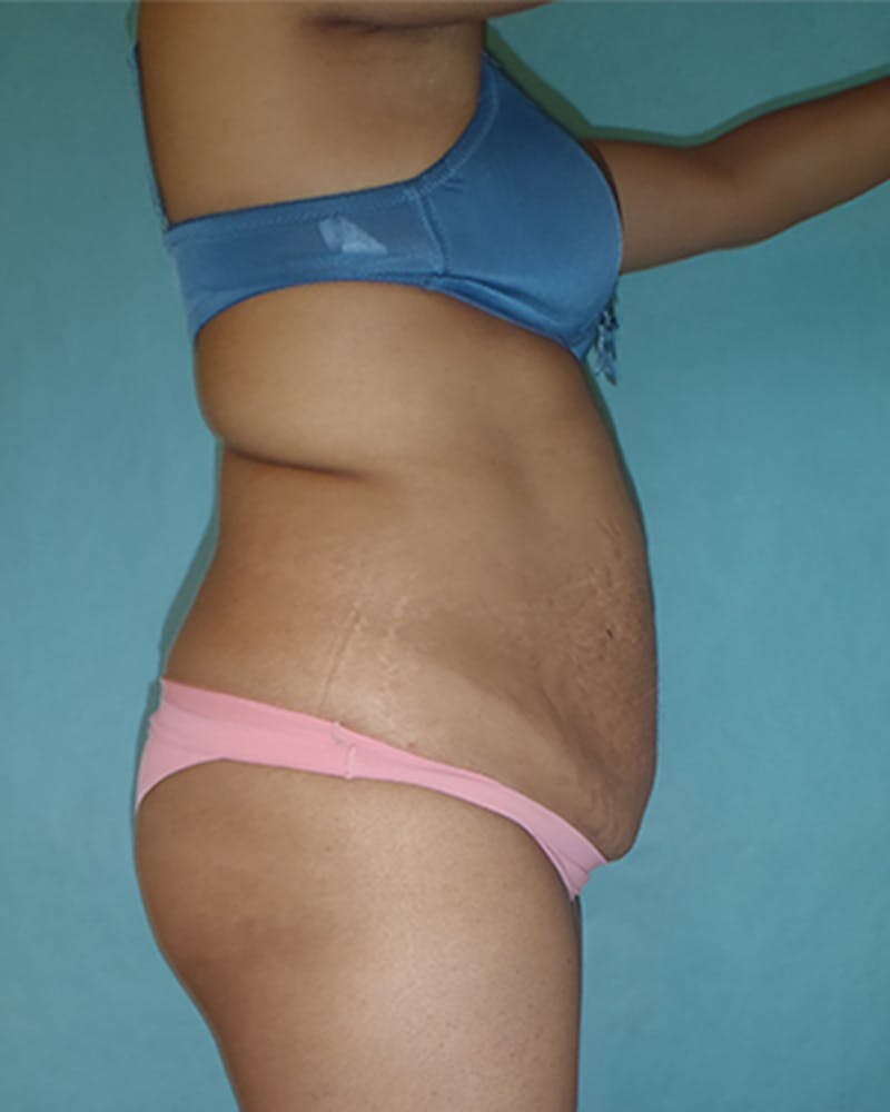 Tummy Tuck Before & After Gallery - Patient 550823 - Image 5