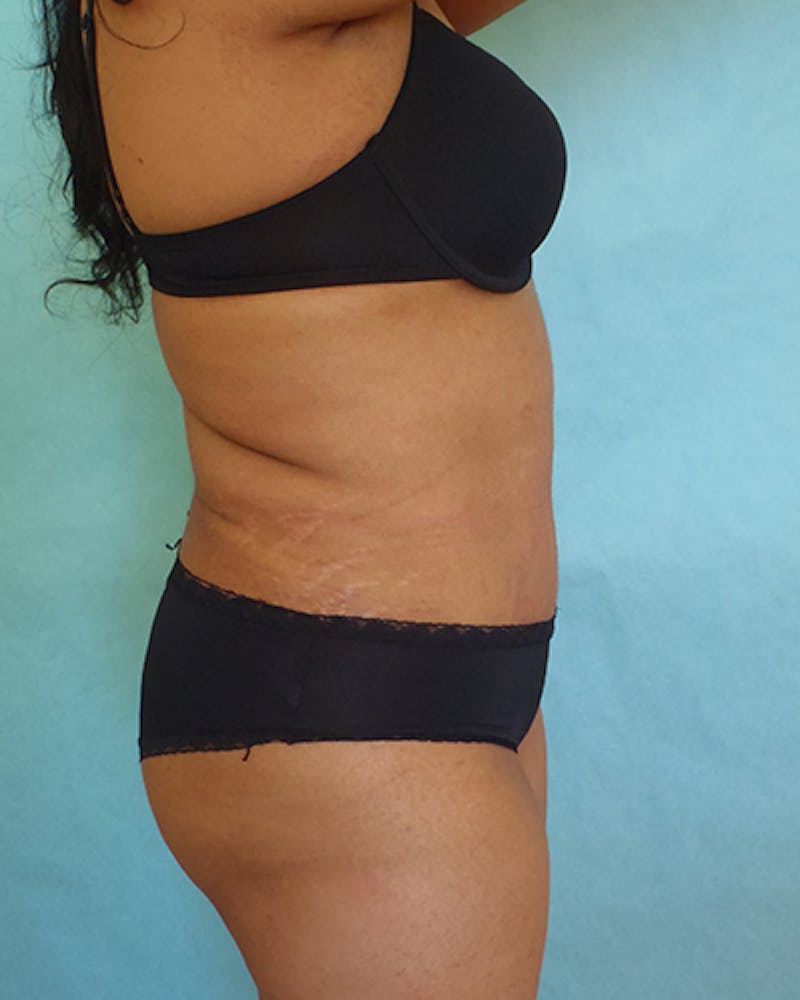Tummy Tuck Before & After Gallery - Patient 550823 - Image 6