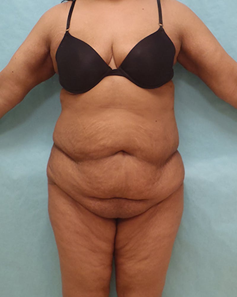 Tummy Tuck Before & After Gallery - Patient 295785 - Image 1