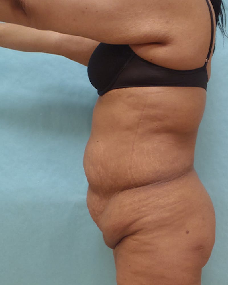 Tummy Tuck Before & After Gallery - Patient 295785 - Image 3