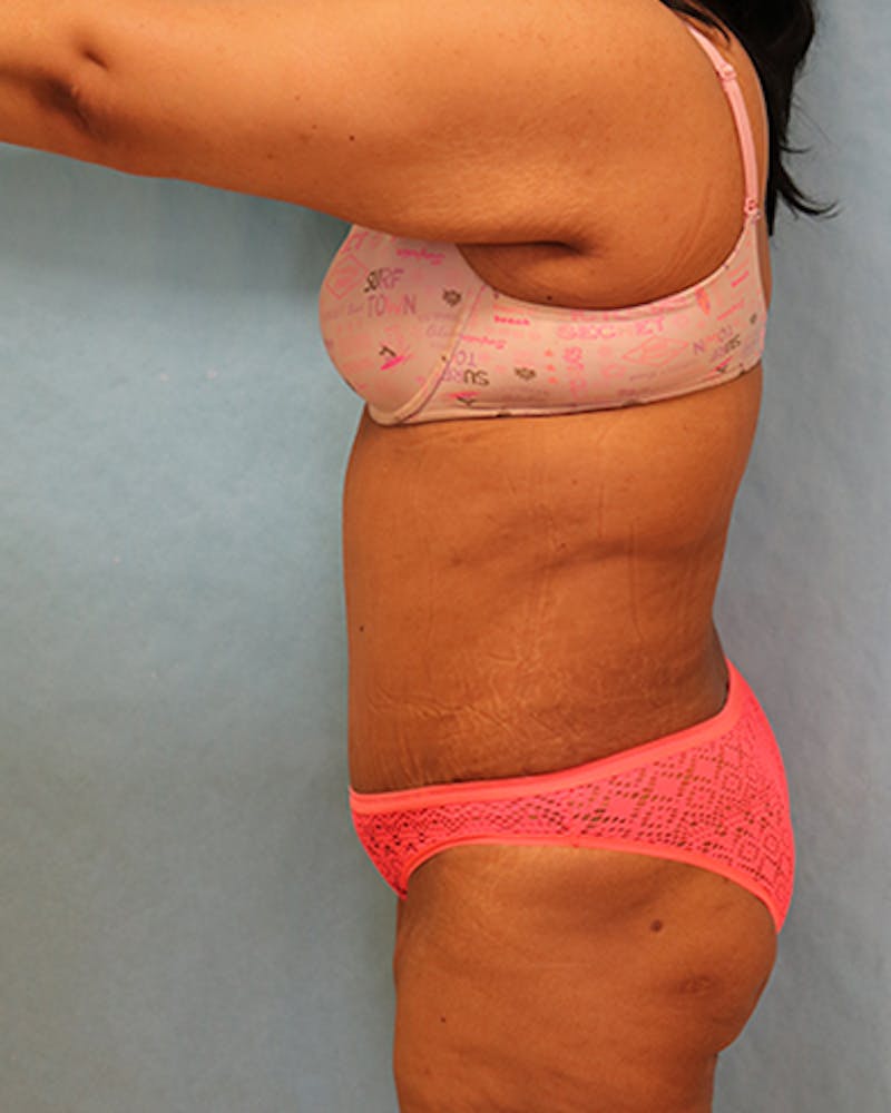 Tummy Tuck Before & After Gallery - Patient 295785 - Image 4