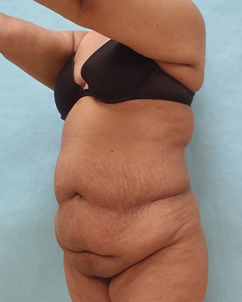 Tummy Tuck Before & After Gallery - Patient 295785 - Image 5