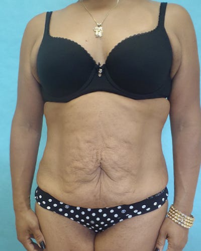 Tummy Tuck Before & After Gallery - Patient 531139 - Image 1