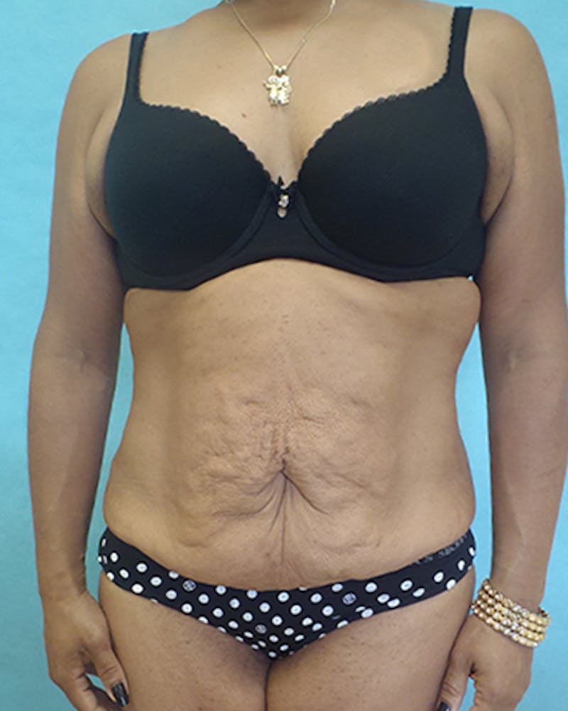 Tummy Tuck Before & After Gallery - Patient 531139 - Image 1