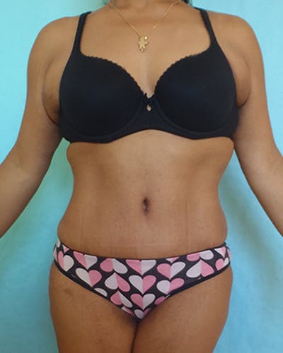 Tummy Tuck Before & After Gallery - Patient 531139 - Image 2