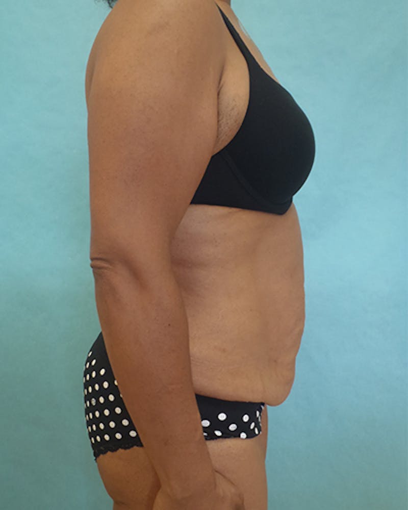 Tummy Tuck Before & After Gallery - Patient 531139 - Image 3