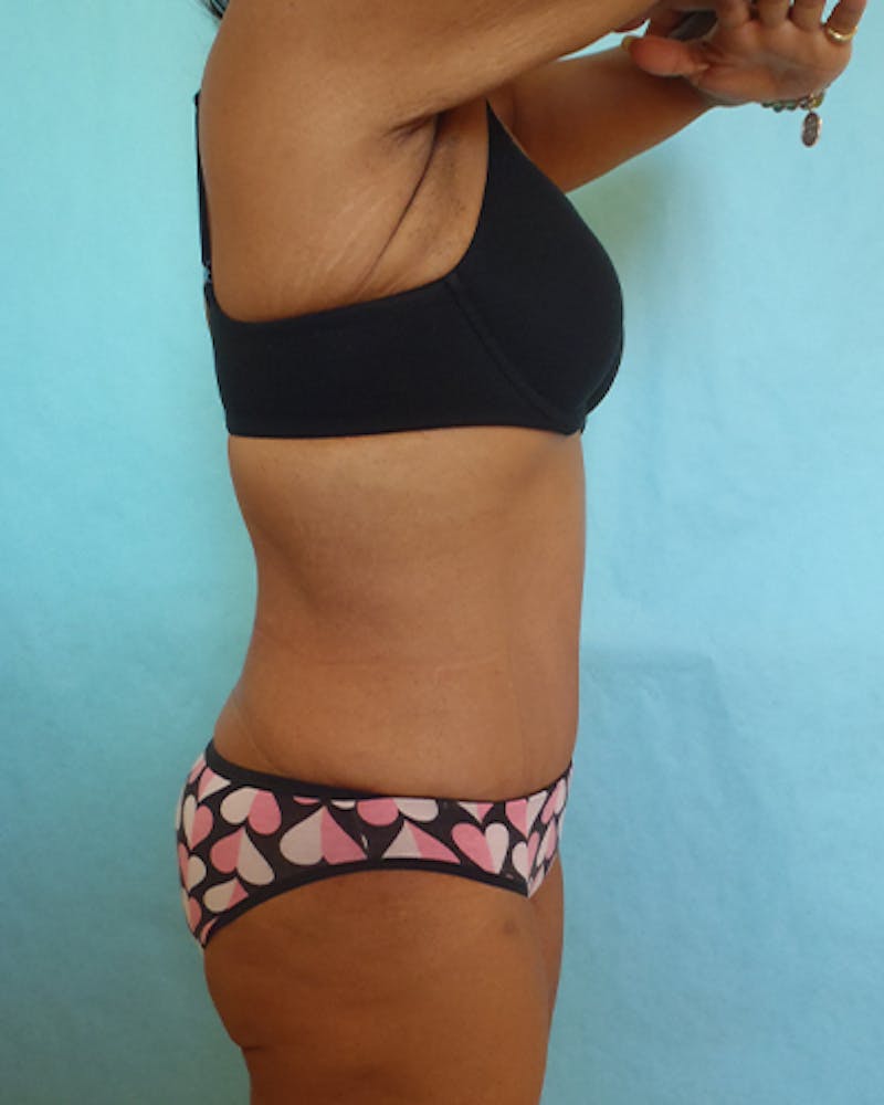 Tummy Tuck Before & After Gallery - Patient 531139 - Image 4