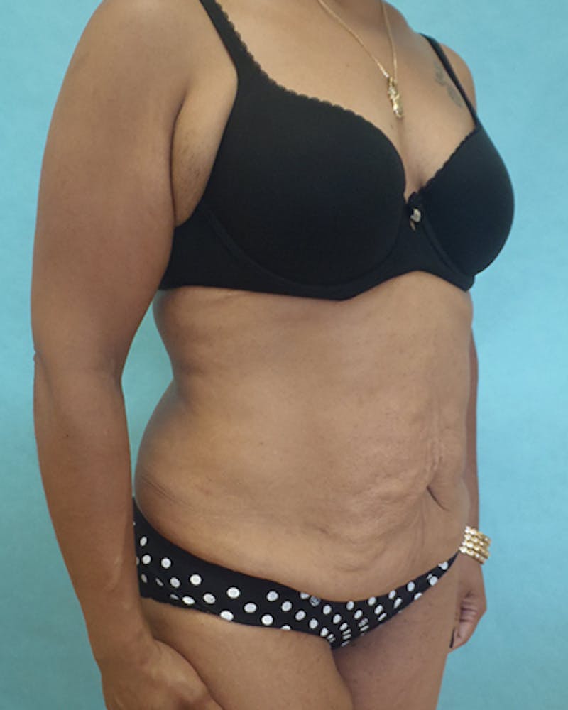 Tummy Tuck Before & After Gallery - Patient 531139 - Image 5