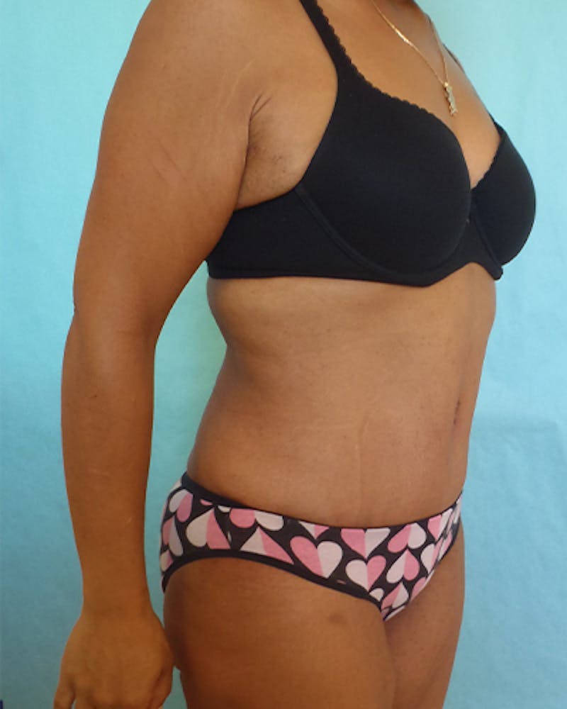 Tummy Tuck Before & After Gallery - Patient 531139 - Image 6