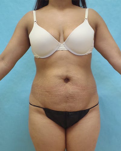 Tummy Tuck Before & After Gallery - Patient 102634 - Image 1