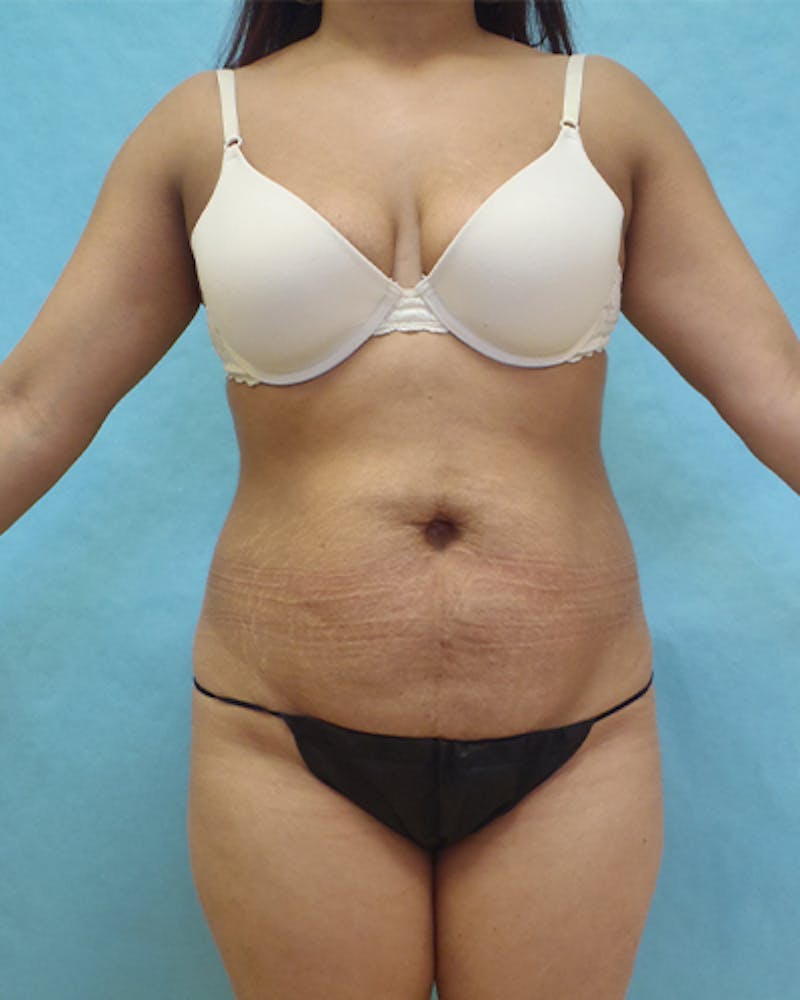 Tummy Tuck Before & After Gallery - Patient 102634 - Image 1