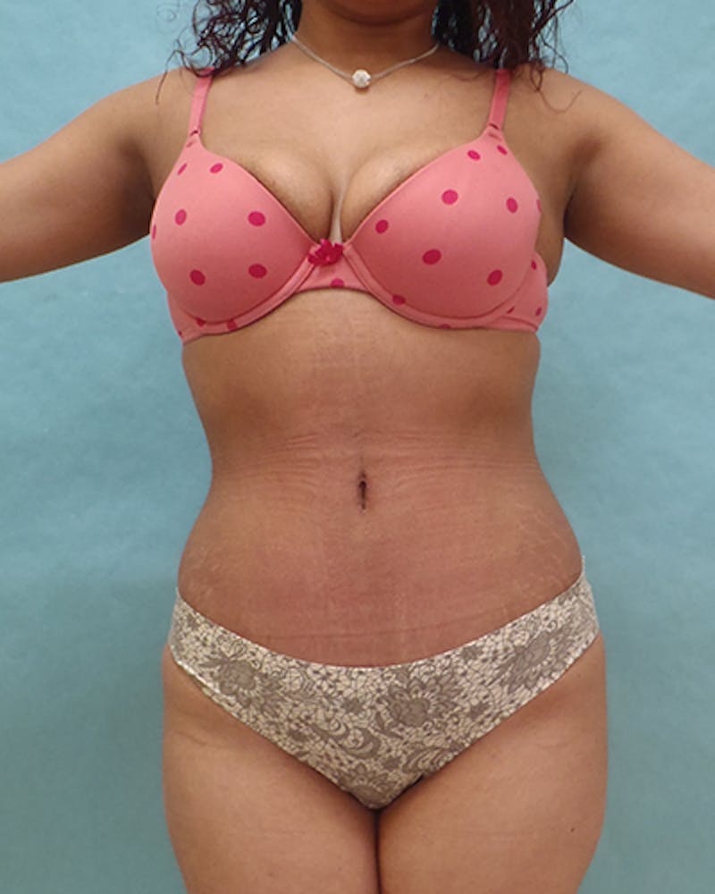 Tummy Tuck Before & After Gallery - Patient 102634 - Image 2