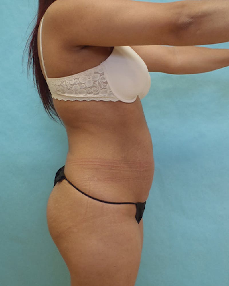 Tummy Tuck Before & After Gallery - Patient 102634 - Image 3