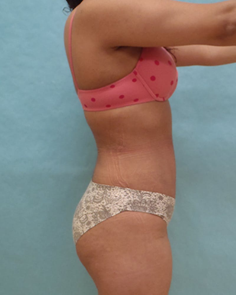 Tummy Tuck Before & After Gallery - Patient 102634 - Image 4