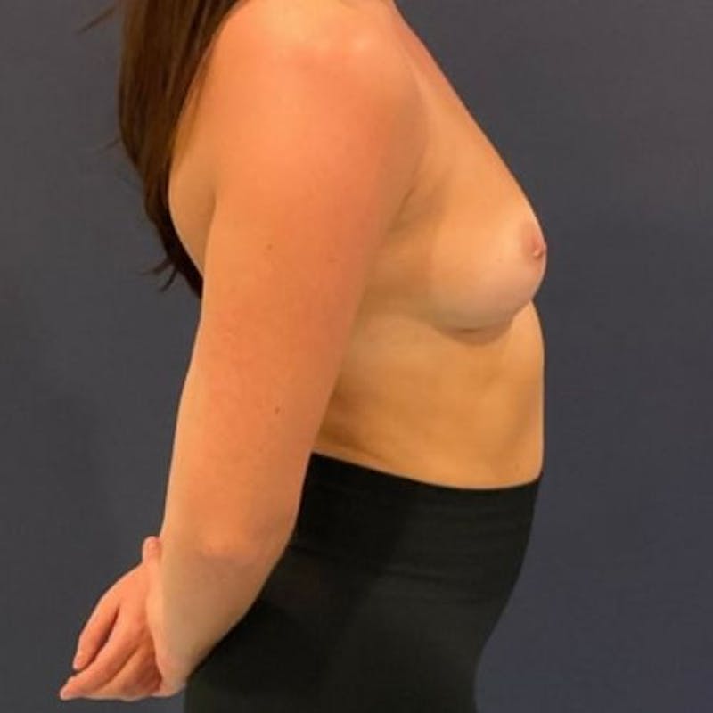 Breast Augmentation Before & After Gallery - Patient 240292 - Image 5