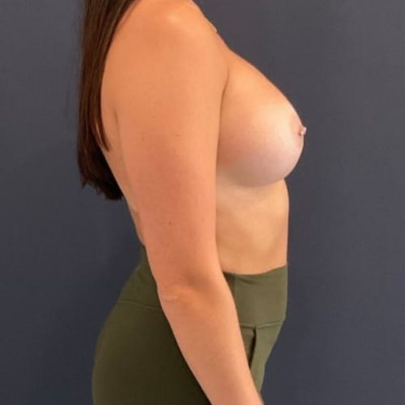Breast Augmentation Before & After Gallery - Patient 240292 - Image 6