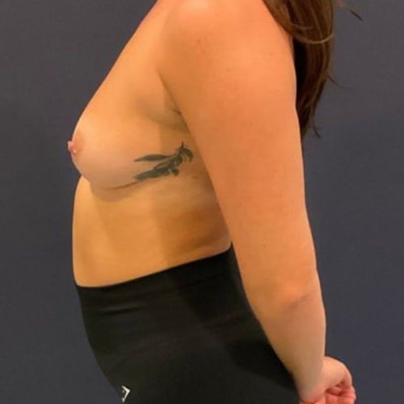 Breast Augmentation Before & After Gallery - Patient 240292 - Image 9