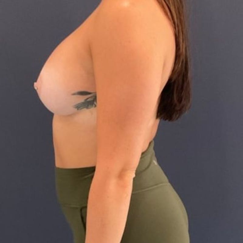 Breast Augmentation Before & After Gallery - Patient 240292 - Image 10