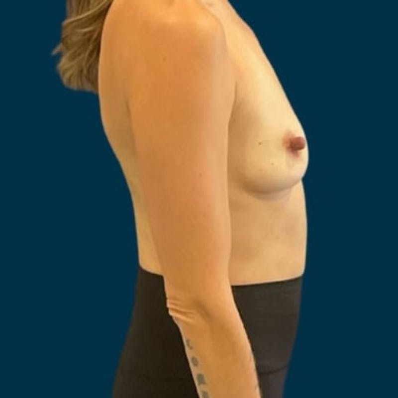 Breast Augmentation Before & After Gallery - Patient 250095 - Image 5