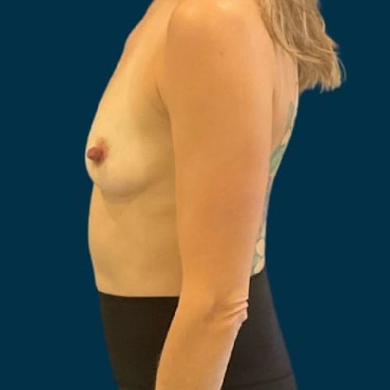 Breast Augmentation Before & After Gallery - Patient 250095 - Image 9