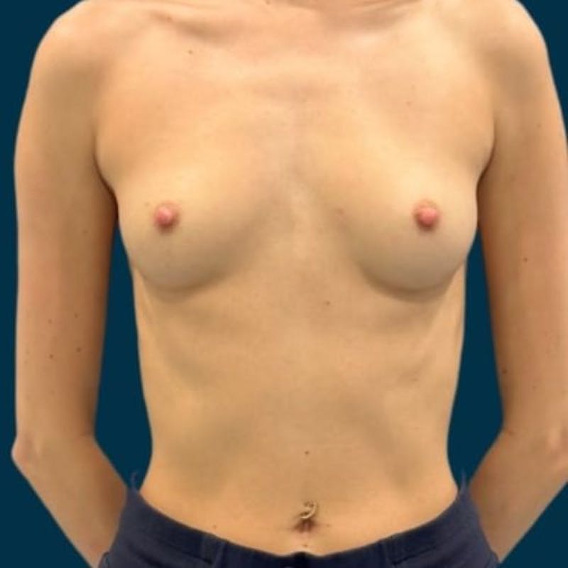 Breast Augmentation Before & After Gallery - Patient 132975 - Image 1